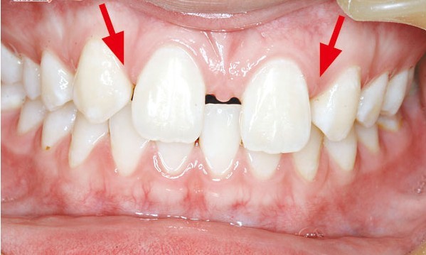 牙齿正畸的人也越来越多,其中儿童先天性牙齿缺失也不少见,牙齿缺失