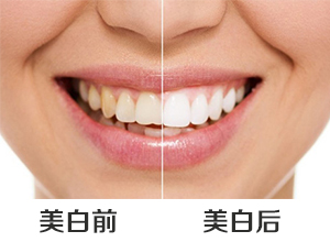 北京朝阳区哪家口腔医院美白牙齿好?