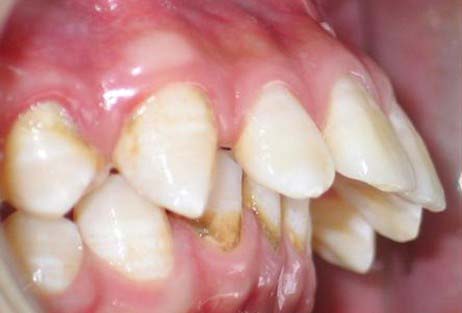 >>>咨询牙管家更清楚 2,影响口腔功能:严重的龅牙可以影响口腔正常
